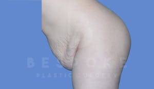 Charlotte NC Body Contouring Results
