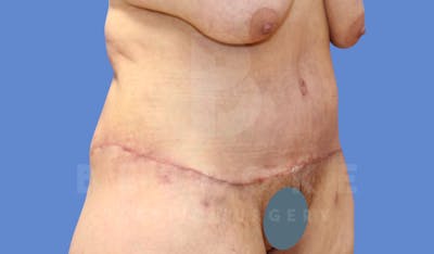 Massive Weight Loss Before & After Gallery - Patient 144294344 - Image 4