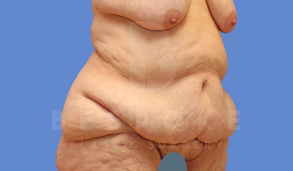 Massive Weight Loss Before & After Gallery - Patient 144294344 - Image 3