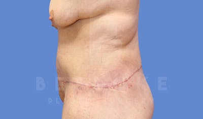 Massive Weight Loss Before & After Gallery - Patient 144294344 - Image 6