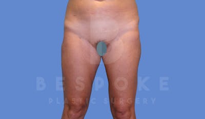 Liposuction Before & After Gallery - Patient 144294365 - Image 2