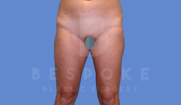 Liposuction Before & After Gallery - Patient 144294365 - Image 2