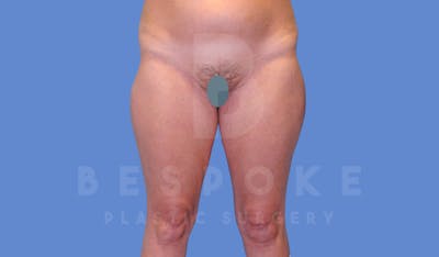 Liposuction Before & After Gallery - Patient 144294365 - Image 1