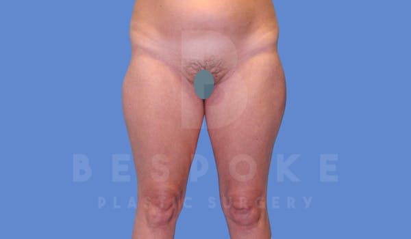 Liposuction Before & After Gallery - Patient 144294365 - Image 1