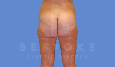 Liposuction Before & After Gallery - Patient 144294365 - Image 4