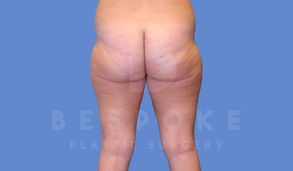 Liposuction Before & After Gallery - Patient 144294365 - Image 3