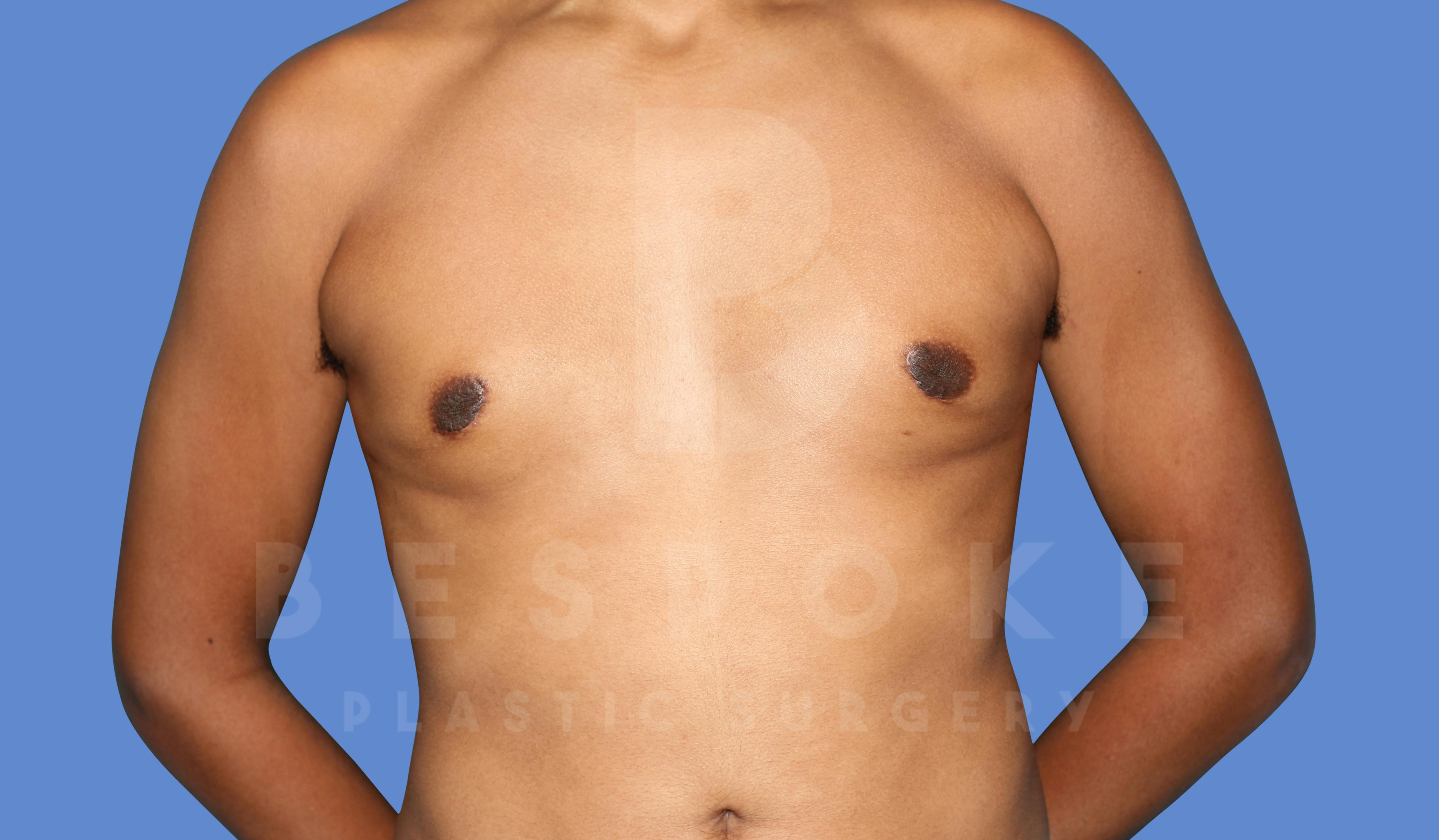 Gynecomastia Before & After Gallery - Patient 144294511 - Image 2