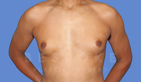 Gynecomastia Before & After Gallery - Patient 144294511 - Image 1