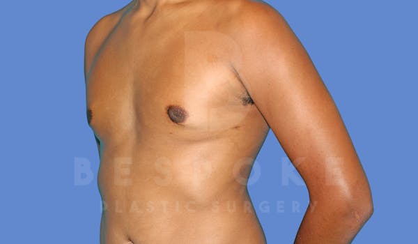 Gynecomastia Before & After Gallery - Patient 144294511 - Image 4