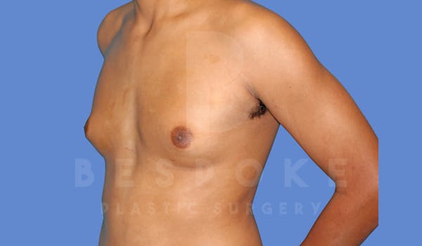 Gynecomastia Before & After Gallery - Patient 144294511 - Image 3