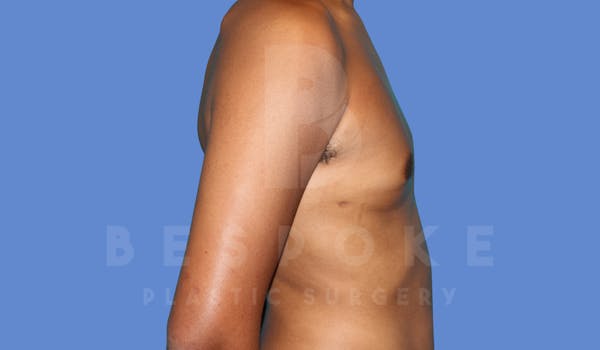 Gynecomastia Before & After Gallery - Patient 144294511 - Image 6