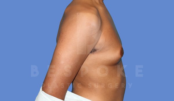 Gynecomastia Before & After Gallery - Patient 144294511 - Image 5