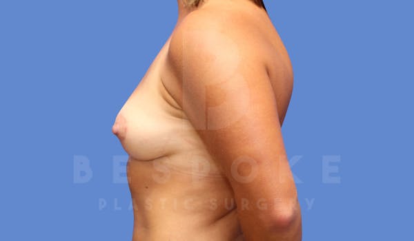Breast Lift (No Implants) Before & After Gallery - Patient 144294535 - Image 6