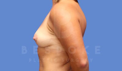 Breast Lift (No Implants) Before & After Gallery - Patient 144294535 - Image 6