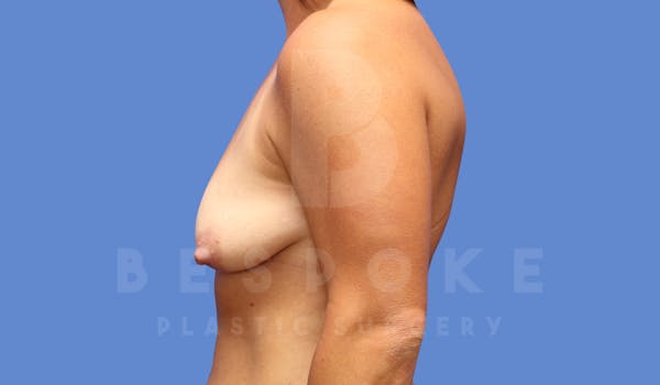 Breast Lift (No Implants) Before & After Gallery - Patient 144294535 - Image 5