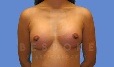 Breast Augmentation Before & After Gallery - Patient 144296335 - Image 2