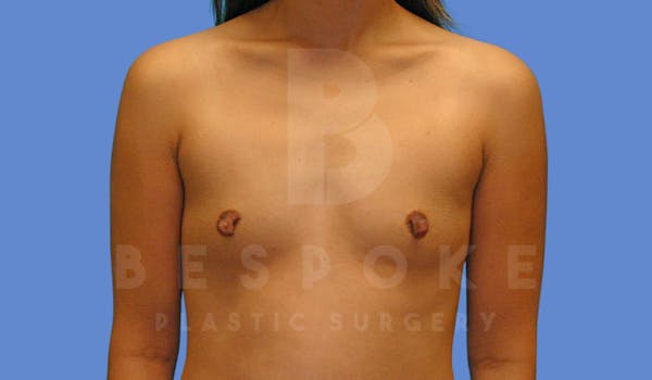 Breast Augmentation Before & After Gallery - Patient 144296335 - Image 1