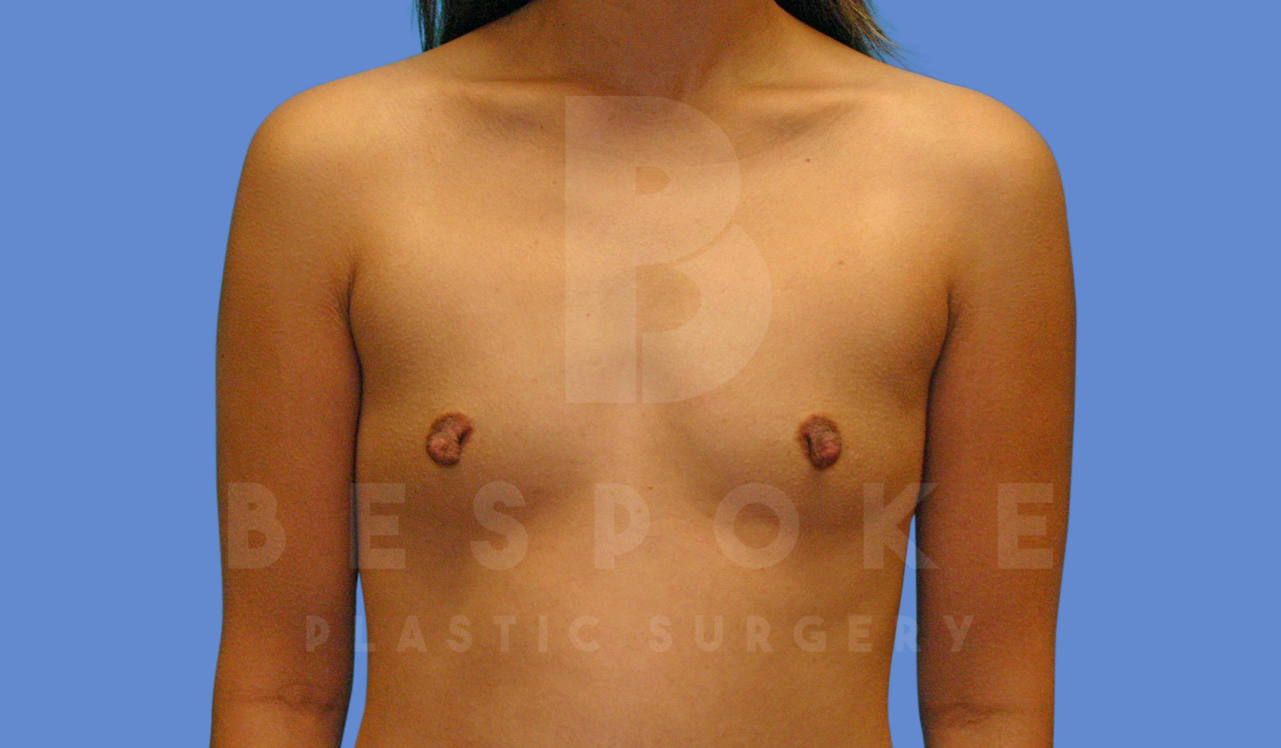 Breast Augmentation Before & After Gallery - Patient 144296335 - Image 1