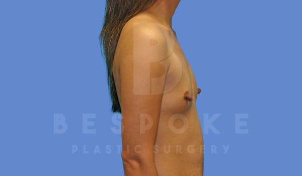 Breast Augmentation Before & After Gallery - Patient 144296335 - Image 5