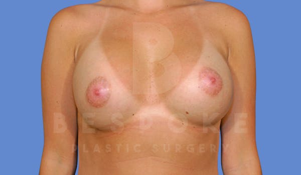 Breast Augmentation Before & After Gallery - Patient 144296334 - Image 2