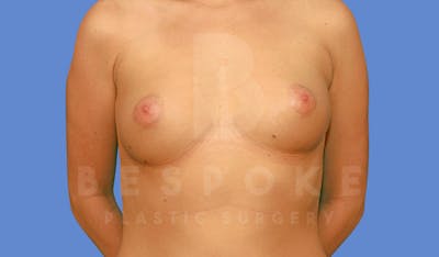 Breast Augmentation Before & After Gallery - Patient 144296334 - Image 1