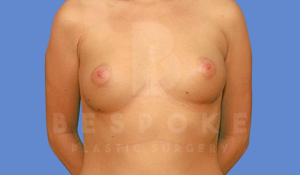 Breast Augmentation Before & After Gallery - Patient 144296334 - Image 1