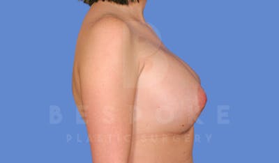 Breast Augmentation Before & After Gallery - Patient 144296334 - Image 6
