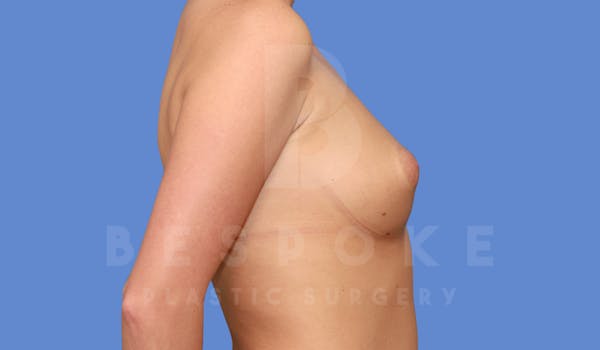 Breast Augmentation Before & After Gallery - Patient 144296334 - Image 5