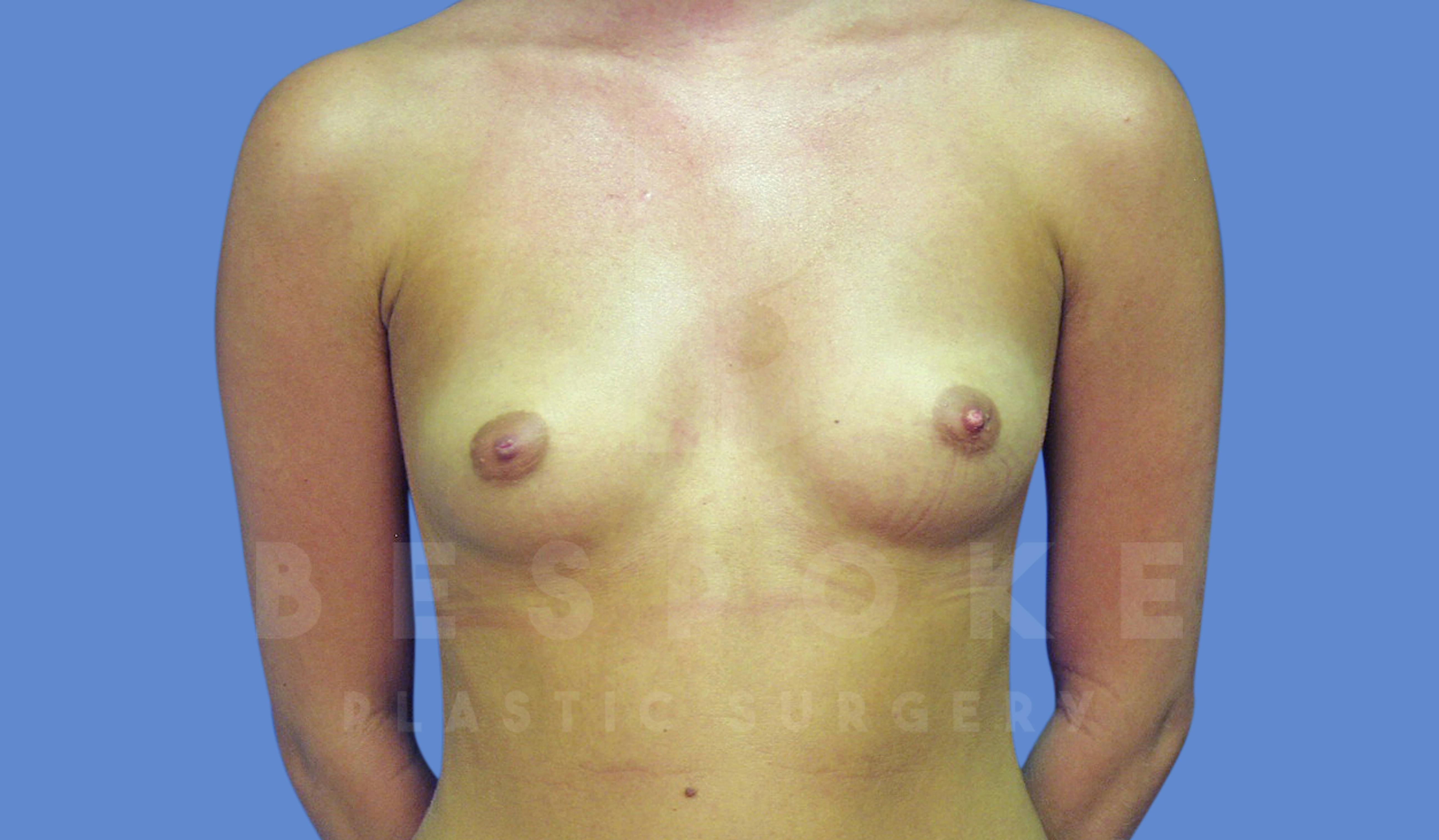 Breast Augmentation Before & After Gallery - Patient 144296336 - Image 1
