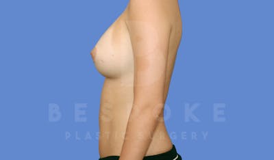 Breast Augmentation Before & After Gallery - Patient 144296336 - Image 6