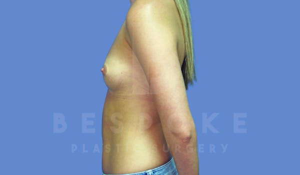 Breast Augmentation Before & After Gallery - Patient 144296336 - Image 5