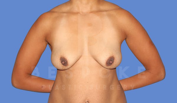 Breast Lift With Implants Before & After Gallery - Patient 144296339 - Image 1