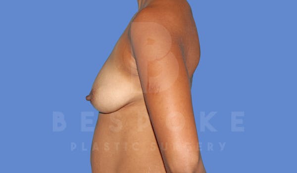 Breast Lift With Implants Before & After Gallery - Patient 144296339 - Image 5