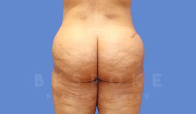 Brazilian Butt Lift Before & After Gallery - Patient 144296349 - Image 2