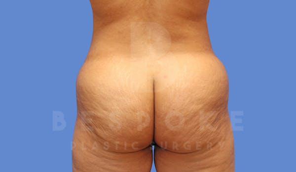 Brazilian Butt Lift Before & After Gallery - Patient 144296349 - Image 1