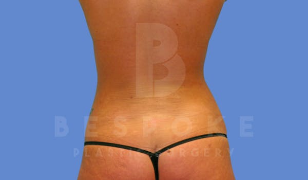 Liposuction Before & After Gallery - Patient 144296353 - Image 2