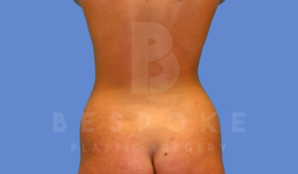 Liposuction Before & After Gallery - Patient 144296353 - Image 1