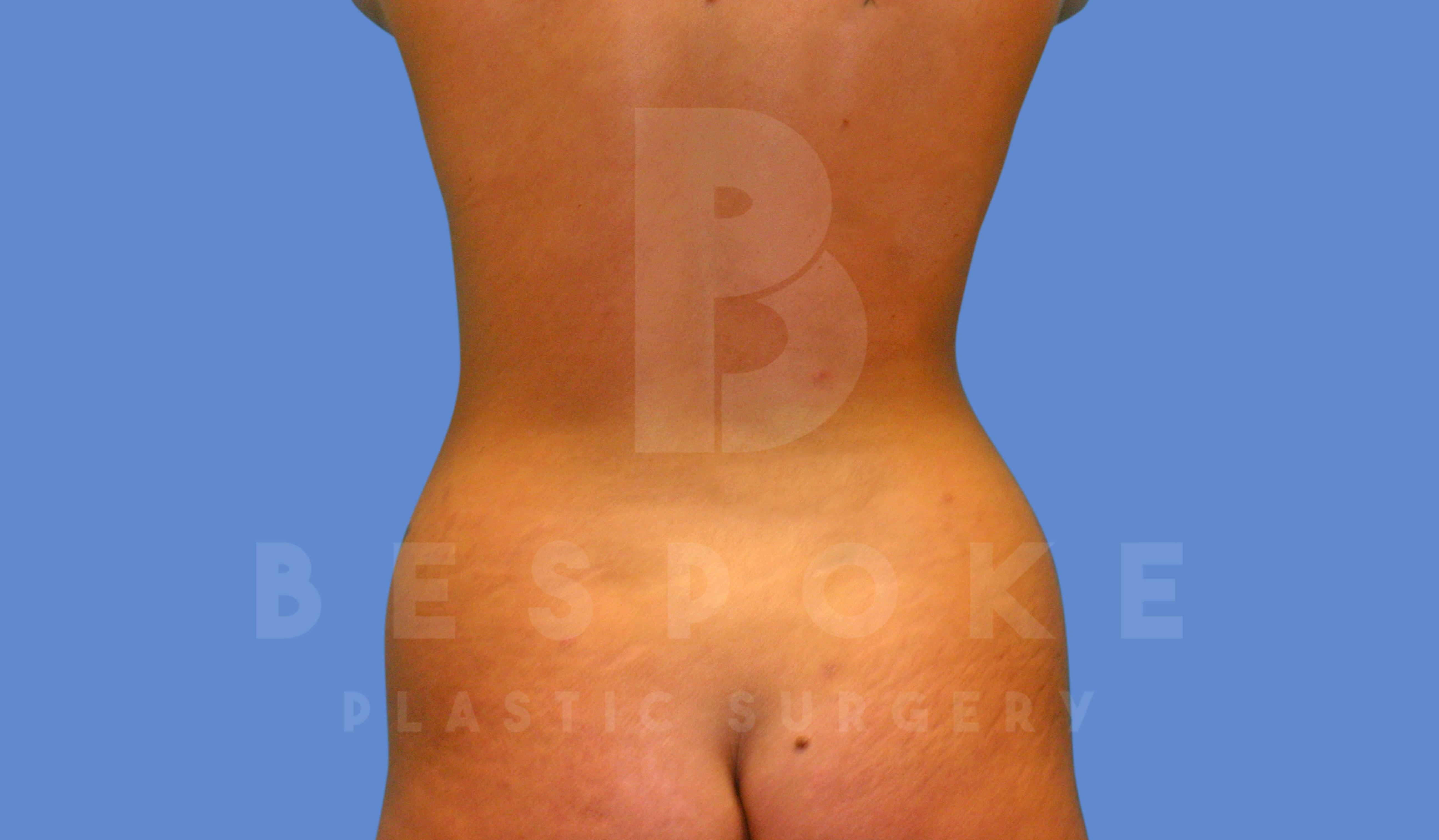 Liposuction Before & After Gallery - Patient 144296353 - Image 1