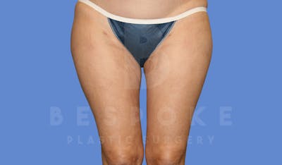 Liposuction Before & After Gallery - Patient 144296355 - Image 2