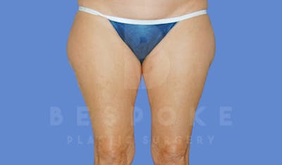 Liposuction Before & After Gallery - Patient 144296355 - Image 1