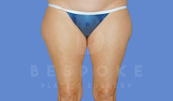 Liposuction Before & After Gallery - Patient 144296355 - Image 1