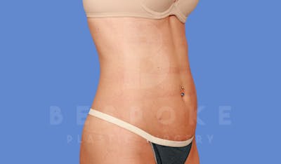 Liposuction Before & After Gallery - Patient 144296359 - Image 2