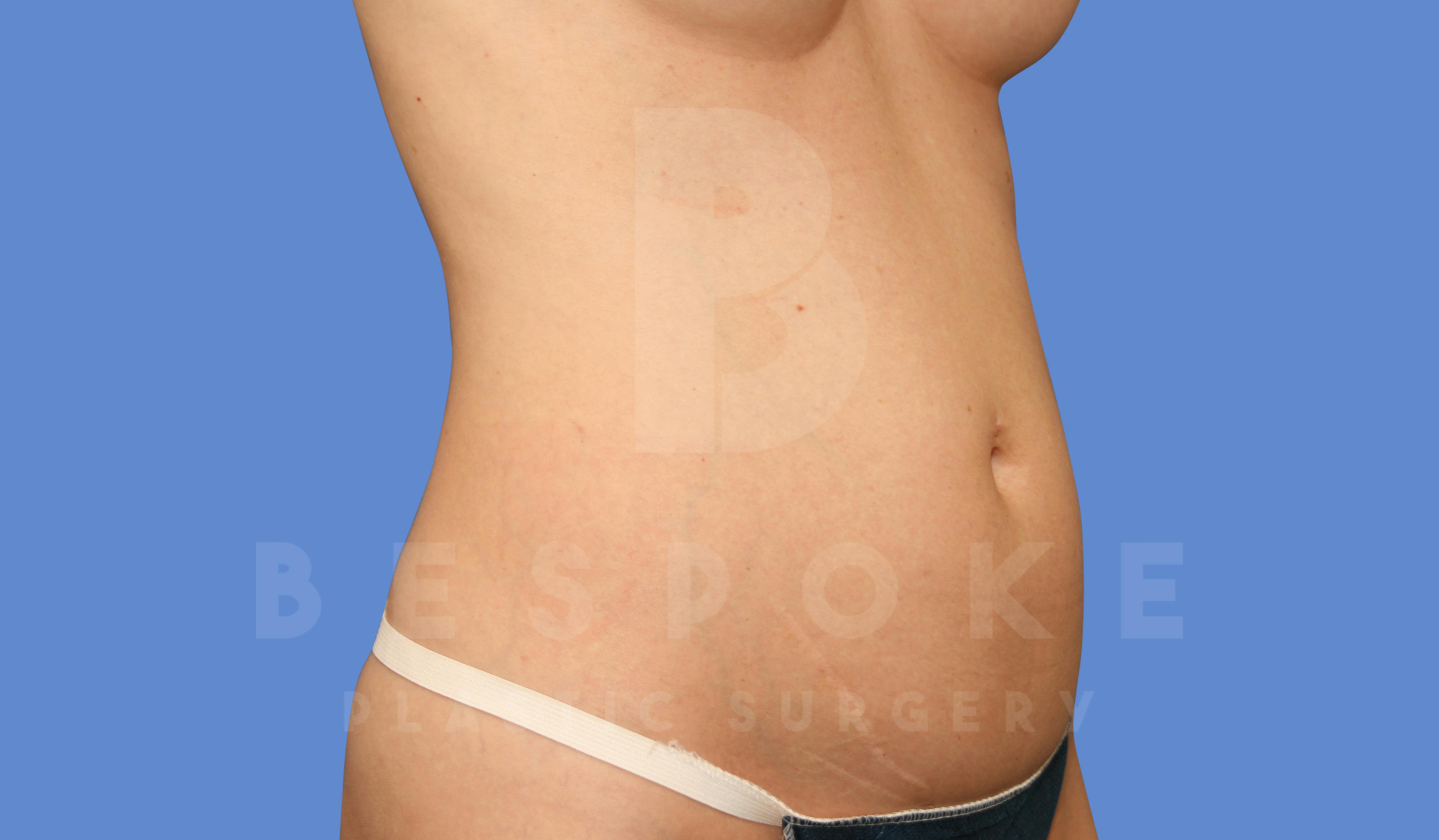 Liposuction Before & After Gallery - Patient 144296359 - Image 1