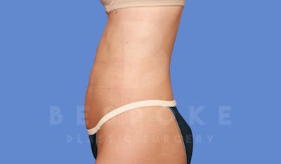 Liposuction Before & After Gallery - Patient 144296359 - Image 4