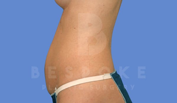 Liposuction Before & After Gallery - Patient 144296359 - Image 3