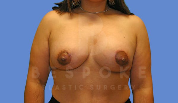 Breast Revision Surgery Before & After Gallery - Patient 144296384 - Image 2