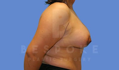 Breast Revision Surgery Before & After Gallery - Patient 144296384 - Image 4
