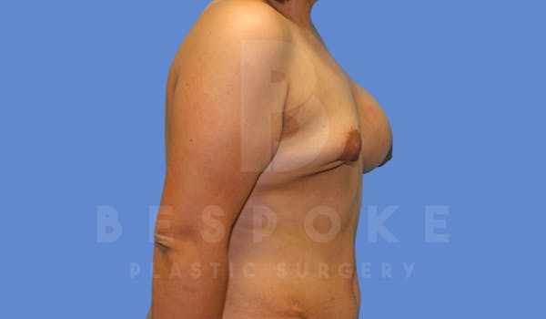Breast Revision Surgery Before & After Gallery - Patient 144296384 - Image 3