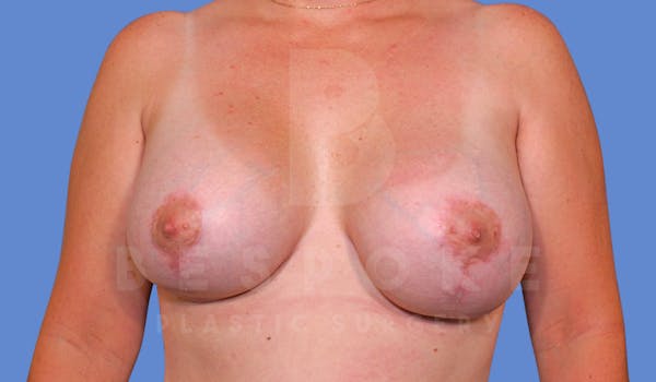 Breast Revision Surgery Before & After Gallery - Patient 144296383 - Image 2
