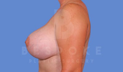 Breast Revision Surgery Before & After Gallery - Patient 144296383 - Image 4